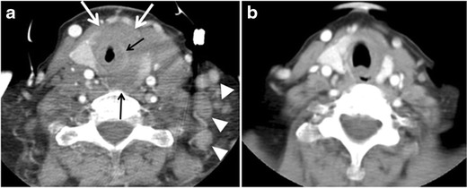 Fig. 11. Thyroid non-Hodgkin's large B-cell lymphoma in a 66-year-old female patient. an Axial enhanced neck CT scan demonstrates left thyroid lobe and isthmus homogeneously hypodense and minimally enhancing mass (white arrows). This lesion invades the prevertebral muscles (black arrows). Note the multiple enlarged level V lymph nodes (white arrowheads). b Post-treatment image shows significant reduction in size and mass effect of the left thyroid infiltrative mass, with almost complete resolution of the left cervical lymphadenopathy.[1]