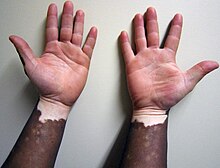 Non-segmental vitiligo on dark skin