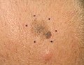 Melanoma, vertex scalp marked for biopsy