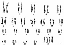 A karyotype, or image of chromosomes, for tetrasomy X. The chromosomes are labelled 1 to 22 for the autosomes (non-ryotype of tetrasomy X