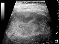 Renal ultrasonograph of acute pyelonephritis with increased cortical echogenicity and blurred delineation of the upper pole[18]