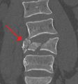 A burst fracture of L4 as seen on CT