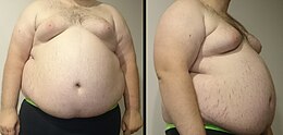 A front and side view of a "Class III male living with obesity" torso. Stretch marks of the skin are visible along with gynecomastia.