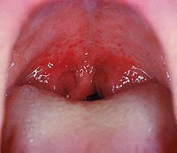 Mouth wide open showing the throat Note the petechiae, or small red spots, on the soft palate. This is an uncommon but highly specific finding in streptococcal pharyngitis.[13]