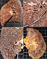 Gross pathology of the lung, spleen and kidney, showing micronodules (1–4 mm in diameter) which resemble millet seeds