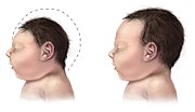 Microcephaly (left) can result from maternal infection during pregnancy