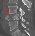 A burst fracture of L4 as seen on CT